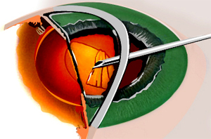 cataract surgery diagram