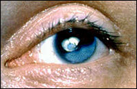 Cataract image 1