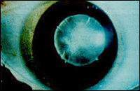 Cataract Image 4